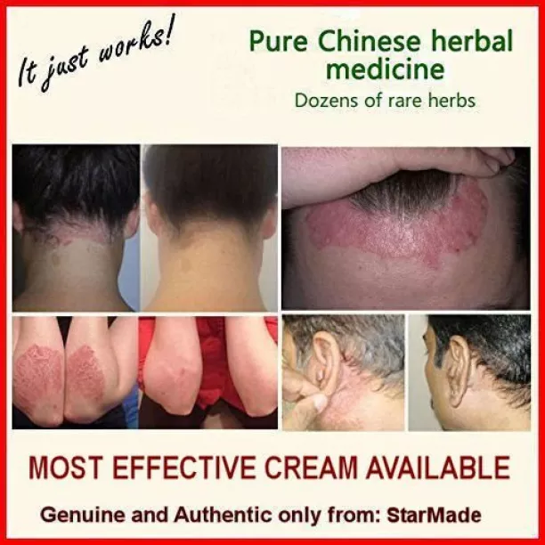 Imported Star Chinese Natural Herbal Eczema Cream Online Sale In Pakis..