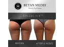 Imported Cellulitix Cellulite Cream And Massager At Online Sale In Pakistan