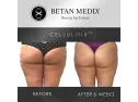 Imported Cellulitix Cellulite Cream And Massager At Online Sale In Pakistan