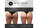 Imported Cellulitix Cellulite Cream And Massager At Online Sale In Pakistan